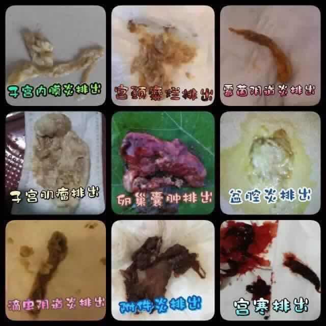 女性生殖保养品:针对白带,异味,月经不调,痛经,霉菌性,滴虫性阴道炎