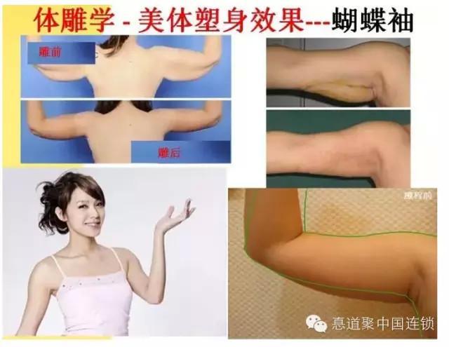 体雕的手法可消除,水牛背,蝴蝶袖,水桶腰,肩颈矫正,美化体形