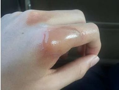烧烫伤紧急救治首选 南法高地薰衣草精油 烧烫伤紧急救治首选 南法高地薰衣草精油