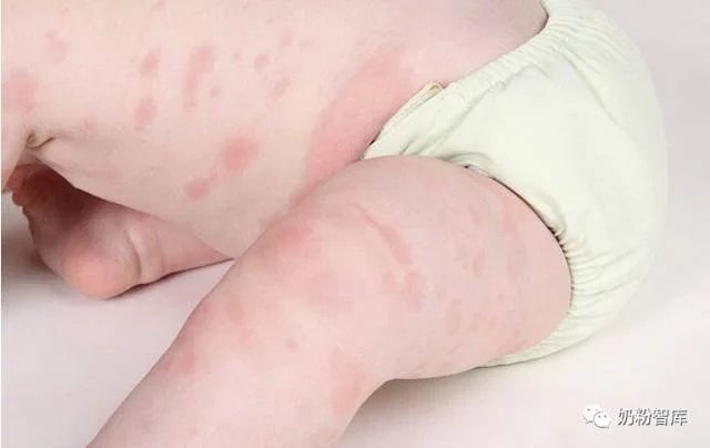 对牛奶过敏 怎么选择奶粉 需要转奶吗 对牛奶过敏 怎么选择奶粉 需要转奶吗