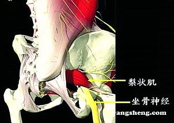 梨状肌综合征的雷火灸疗法