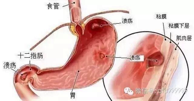 胃 你好吗 胃 我不好 怎么办 胃肠疾病黄金搭档 恒瑞宝和安发奶片