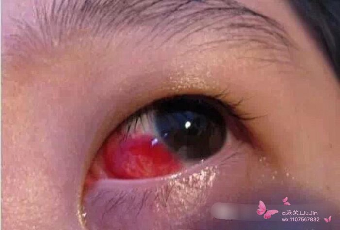 眼白为什么不白了 眼白出现这个颜色 你要小心了