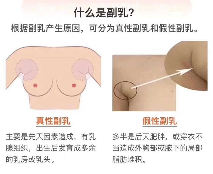 为什么有的女生会有副乳